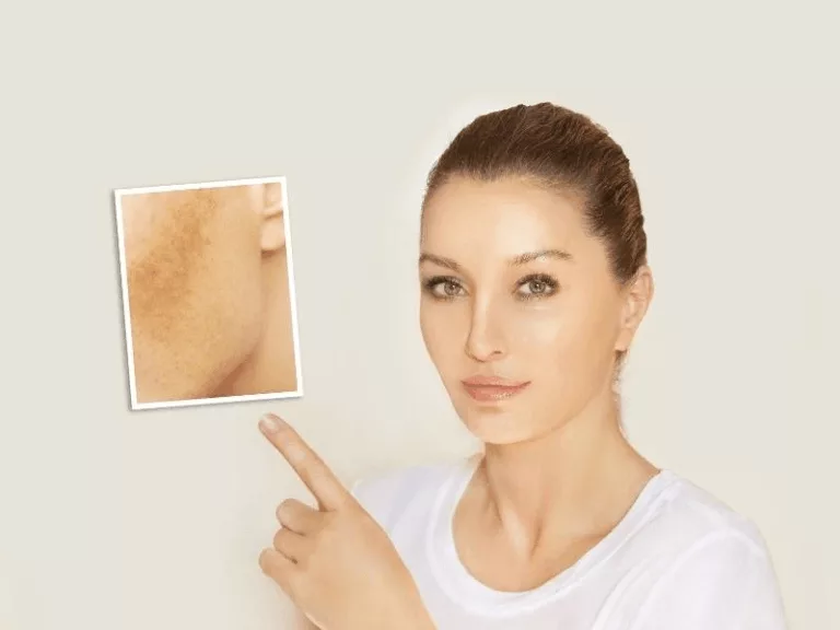 3 Ätherische Öle gegen Sonnenbrand